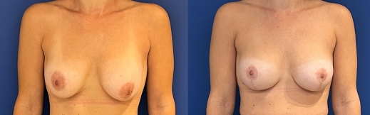 הרמת חזה עם שתל - 36 - פרונט הרמת חזה עם שתל - 36 - פרונט