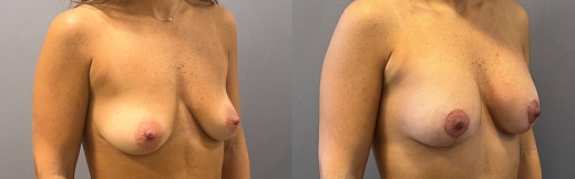 הרמת חזה עם שתל - 37 - ימין הרמת חזה עם שתל - 37 - ימין