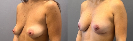 הרמת חזה עם שתל - 37 - שמאל הרמת חזה עם שתל - 37 - שמאל