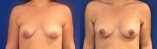 הרמת חזה עם שתל - 39 - פרונט הרמת חזה עם שתל - 39 - פרונט