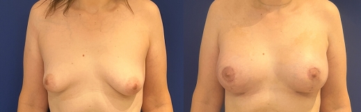 הרמת חזה עם שתל - 42 - פרונט הרמת חזה עם שתל - 42 - פרונט