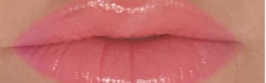 חומצה היאלורונית בשפתיים לפני ואחרי 