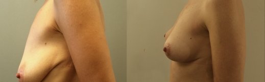לפני ואחרי ניתוח הרמת חזה