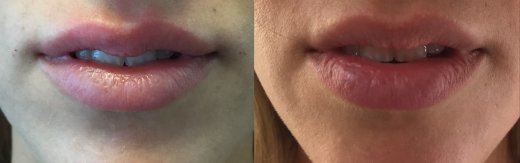 מילוי-שפתיים-לפני-ואחרי