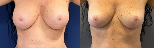 מתיחת בטן - 29- פרונט