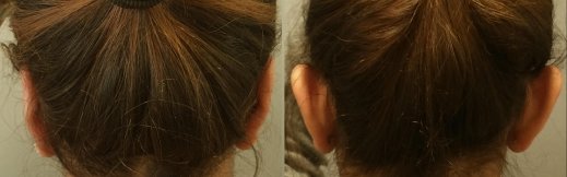 ניתוח הצמדת אוזניים צד אחורי מלא