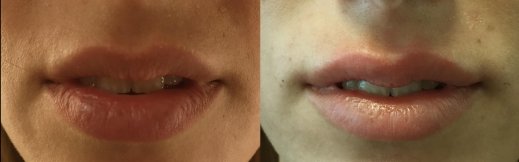 עיבוי שפתיים עם חומצה היאלורונית