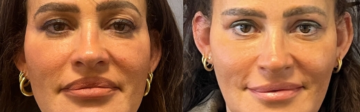 עפעפיים-13 - פרונט עפעפיים-13 - פרונט